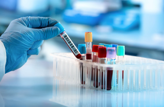 [빅테크칼럼] "혈액검사로 췌장암 조기발견?"…'침묵의 살인자'에 도전장, 4중 바이오마커 혈액검사 AUC 0.97로 조기진단 혁신